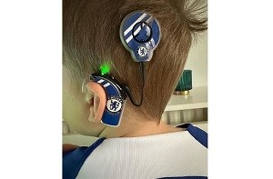 Close-up of William's cochlear implants which are decorated with Chelsea Football Club stickers