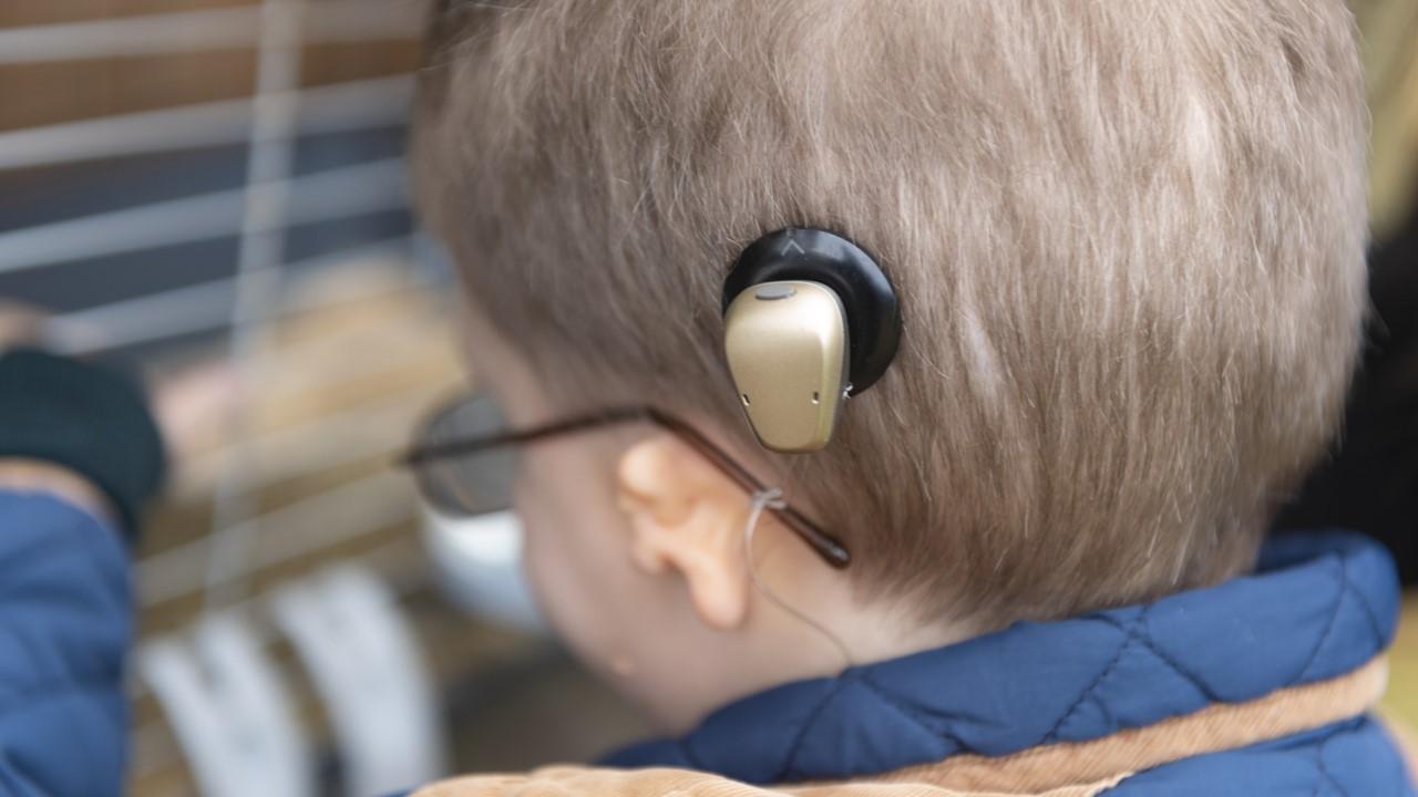 Boy wearing a bone conduction implant magnet.