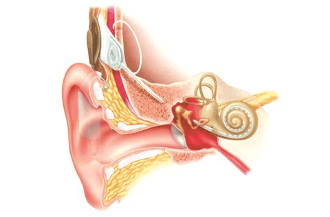 Diagram showing how the internal part of a cochlear implant is connected to the auditory nerve.