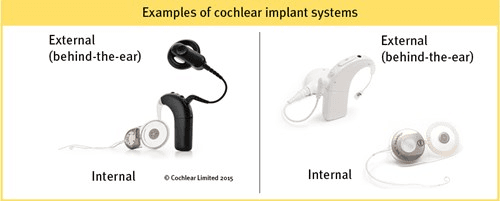 Two example images showing the external and internal parts of cochlear implants