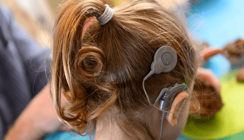 The back of a child's head with a cochlear implant sound processor and transmitting coil attached.