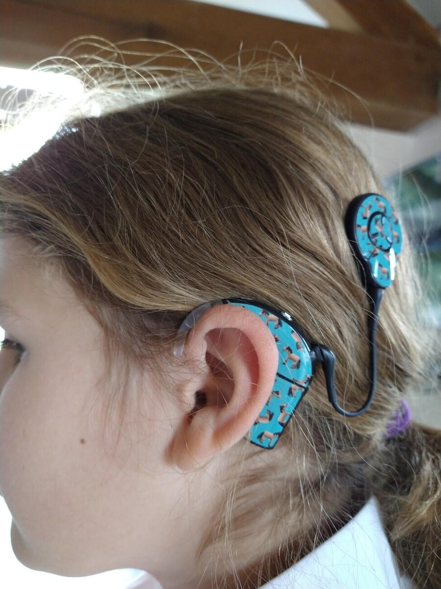 Girl with a cochlear implant that has a horse-themed skin on it
