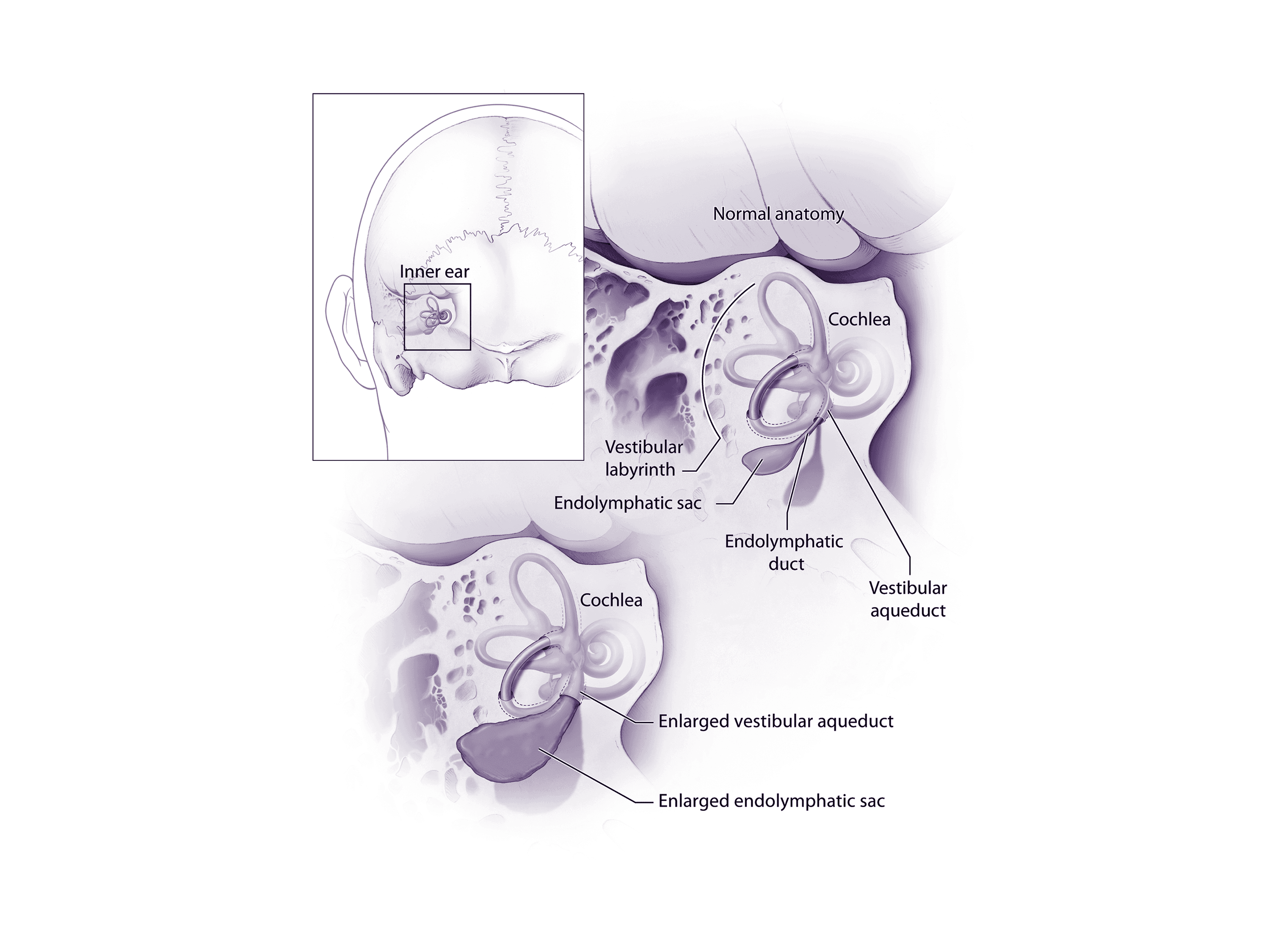 A diagram explaining how enlarged vestibular aqueducts affect hearing.