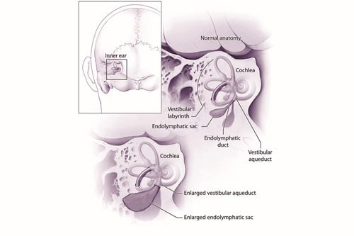 Diagram showing the inner ear with enlarged vestibular aquaducts