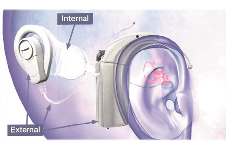 Diagram showing the internal and external parts of the cochlear implant.