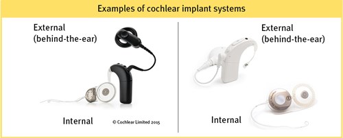 Beispiele für Cochlea–Implantatsysteme