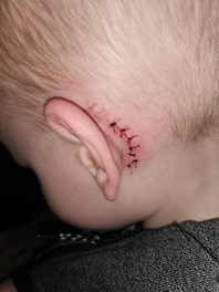 Photo behind the ear showing a scar