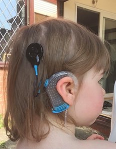 Girl's cochlear implant