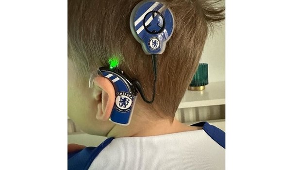 Close up of William's cochlear implants, which are decorated with Chelsea Football Club stickers