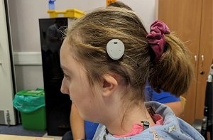 Close-up of Chloe's Cochlear Osia bone conduction implant